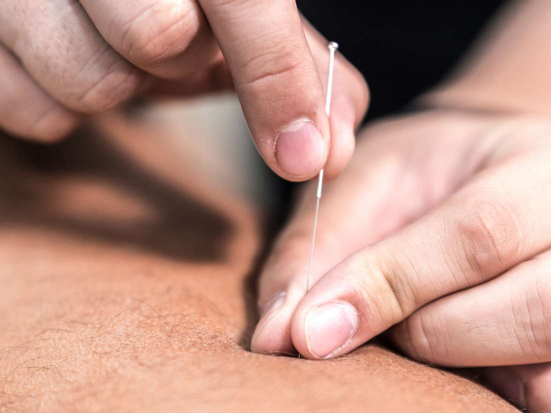 Many practitioners say that acupuncture can help relieve the symptoms of psoriasis and psoriatic arthritis._0