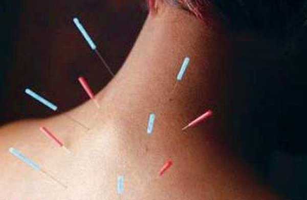 This study indicates that acupuncture improves disease activity, quality of life and general well-being of patients with Ulcerative Colitis._0