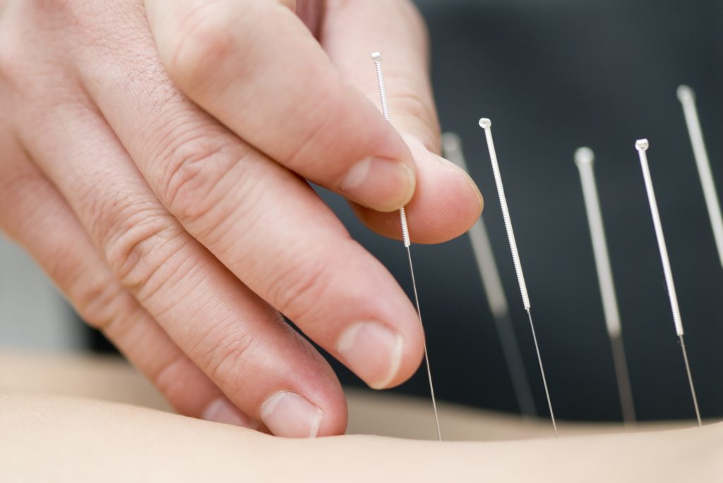 New FDA guidelines recommend doctors get information on acupuncture to help with pain management._0