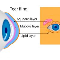 Dry eyes? Try acupuncture before you turn to medicine.