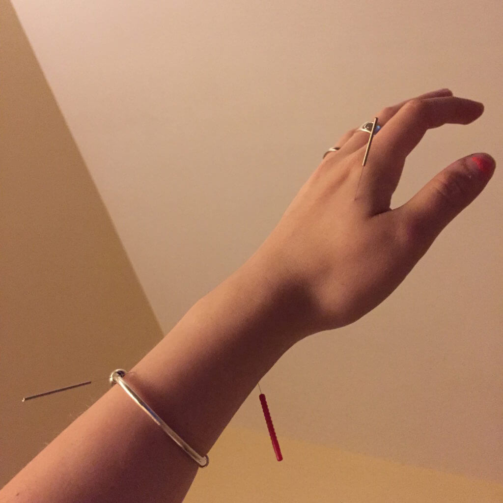 Check out why this well-known blogger tried acupuncture and how it worked for her!_0